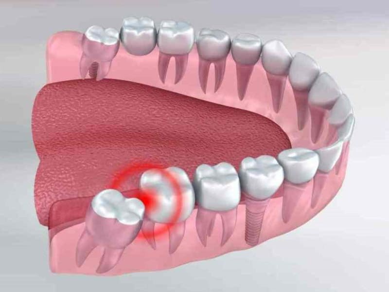 Các cách giảm đau khi mọc răng khôn