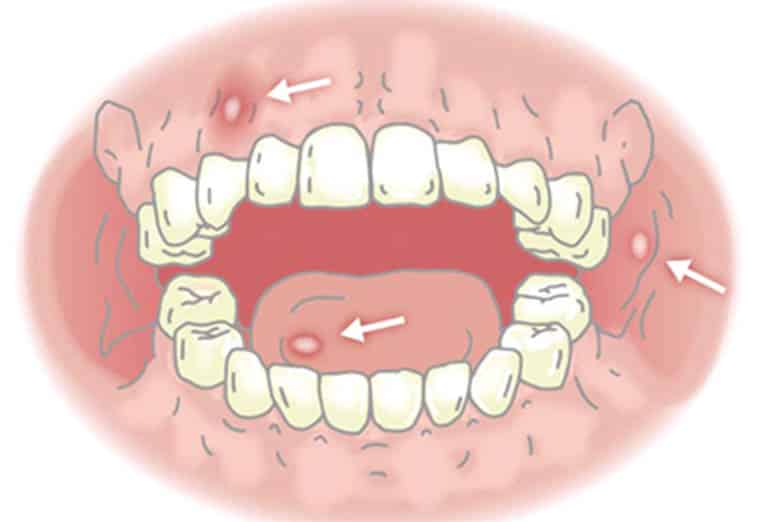 Những cách trị nhiệt miệng hiệu quả nhất bạn đã biết hay chưa?