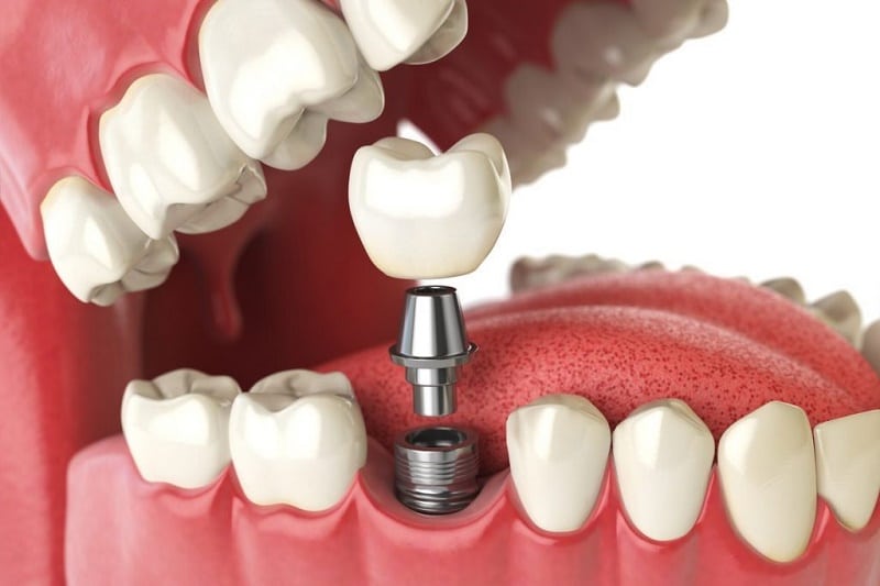 Tổng hợp 7 lợi ích của trồng răng implant là gì?