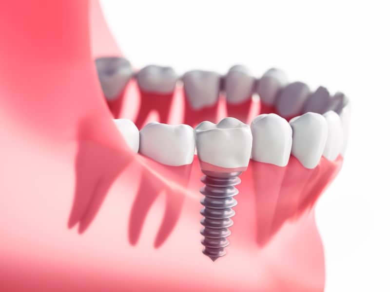 Tổng hợp 7 lợi ích của trồng răng implant là gì?