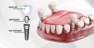 Tổng hợp 7 lợi ích của trồng răng implant là gì?