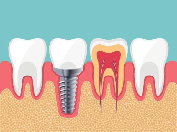 Tổng hợp 7 lợi ích của trồng răng implant là gì?