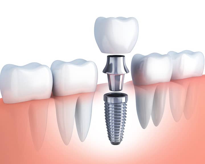 Tổng hợp 7 lợi ích của trồng răng implant là gì?