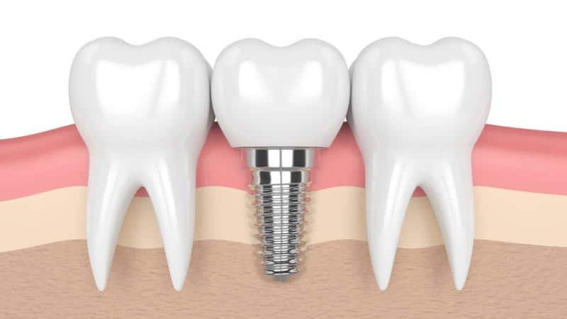 Tổng hợp 7 lợi ích của trồng răng implant là gì?